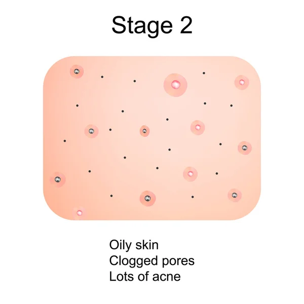 Etapa 2 del desarrollo del acné. Piel inflamada con cicatrices, acné y granos. La textura de la piel inflamada, acné y granos. Infografías. Ilustración vectorial . — Vector de stock