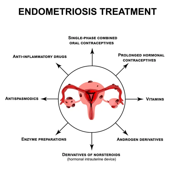 Tratamiento de la endometriosis. Adenomiosis. Estructura de los órganos pélvicos con endometriosis. Infografías. Ilustración vectorial sobre fondo aislado . — Archivo Imágenes Vectoriales