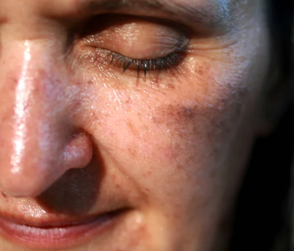 красные пятна на лице у носа. лентиго, хлоазма, веснушки. стрептококковое лентиго. лентиго, хлоазма, веснушки. пятно на скуле лица.