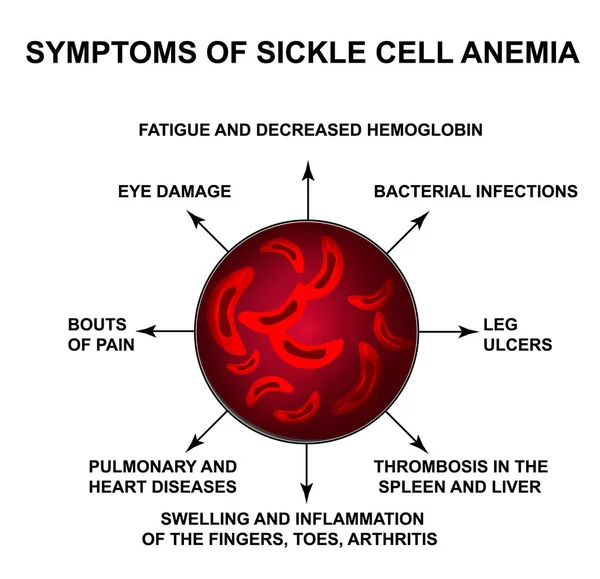 Symptoms of sickle cell anemia. World Sickle Cell Anemia Day 19 June. Red blood cells. Erythrocytes Sickle. Infographics. Vector illustration on isolated background. — Stock Vector