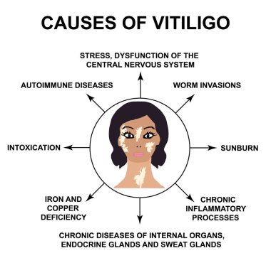 Vitiligo nedenleri. Dünya Vitiligo Günü. ınfographics. Yalıtılmış arka planda vektör çizimi.