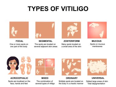 Vitiligo türleri. Dünya Vitiligo Günü. ınfographics. Yalıtılmış arka planda vektör çizimi.