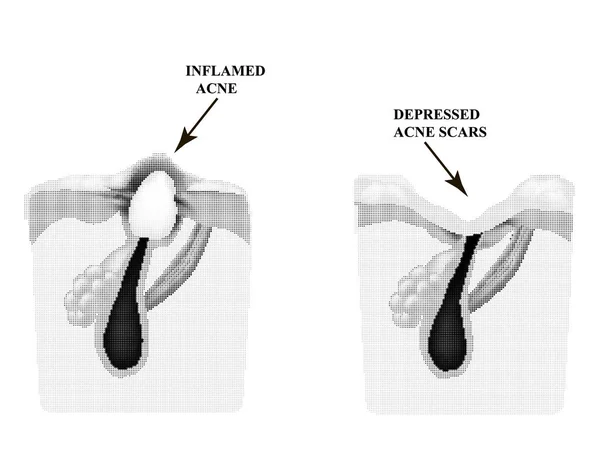 Acné inflamado en la piel. Espinilla inflamada. La estructura de la piel. Cicatriz de acné . — Vector de stock