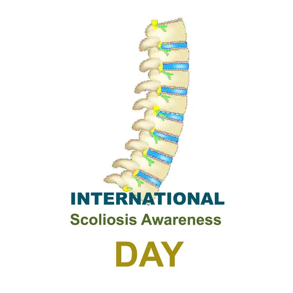 Día Mundial de la Escoliosis. Escoliosis de la columna vertebral. Infografías. Ilustración vectorial sobre fondo aislado . — Vector de stock