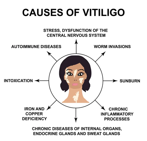 Causas de Vitiligo. Día Mundial del Vitiligo. Infografías. Ilustración vectorial sobre fondo aislado . — Vector de stock