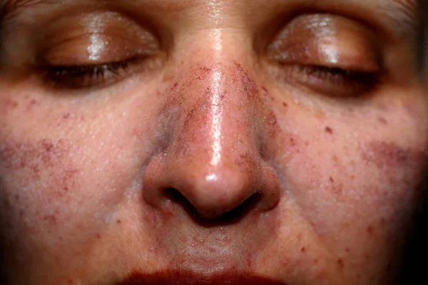 Pigmented spots on the face. Pigmentation on cheeks — Stock Photo, Image