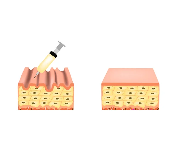 皮膚のしわ。ボトックスしわ治療。解剖学的皮膚構造。ボトックス注射インフォグラフィック。分離された背景のベクトルイラストレーション. — ストックベクタ