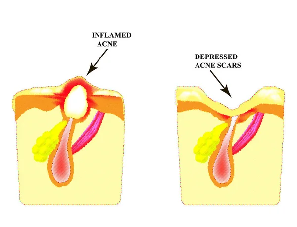 Acné inflamado en la piel. Espinilla inflamada. La estructura de la piel. Cicatriz de acné . — Vector de stock