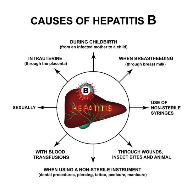 Causas de la hepatitis B. Día Mundial de la Hepatitis. Infografías. Ilustración vectorial sobre fondo aislado . — Vector de stock