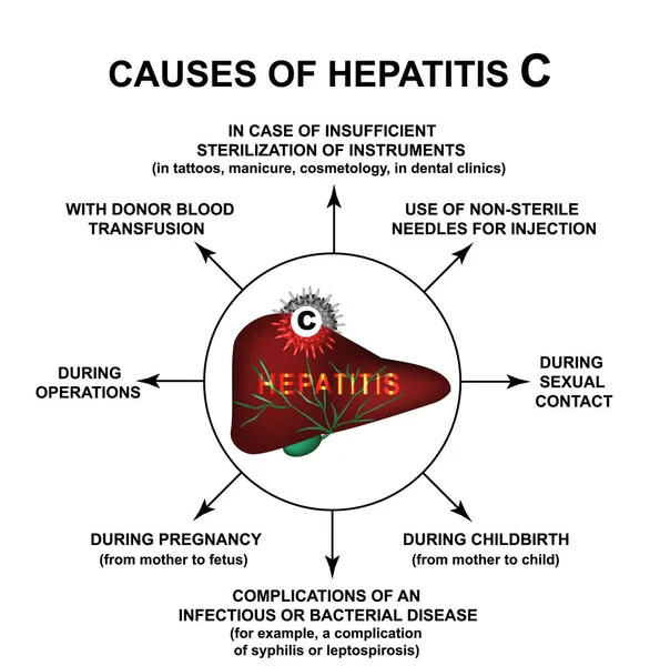 Causas de la hepatitis C. Día Mundial de la Hepatitis. Infografías. Ilustración vectorial sobre fondo aislado . — Vector de stock