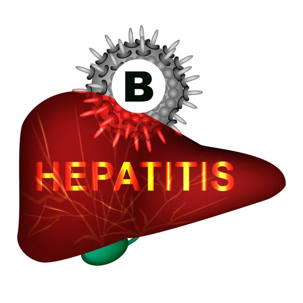 Гепатит B. Всемирный день борьбы с гепатитом. Инфографика. Векторная иллюстрация на изолированном фоне . — стоковый вектор