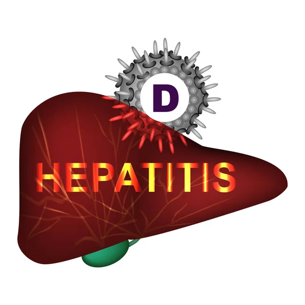 Hepatitis D. Día Mundial de la Hepatitis. Infografías. Ilustración vectorial sobre fondo aislado . — Vector de stock
