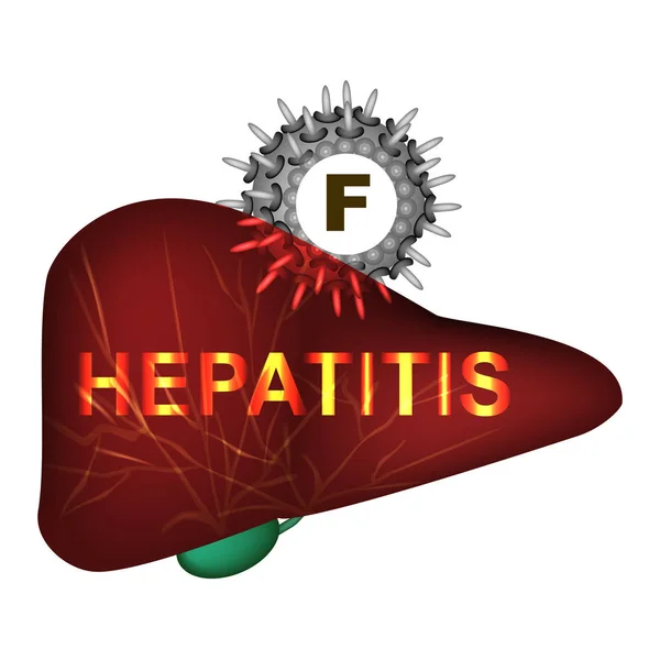 Hepatitis F. Día Mundial de la Hepatitis. Infografías. Ilustración vectorial sobre fondo aislado . — Vector de stock