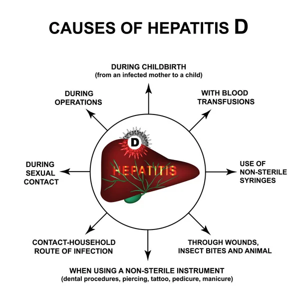 Okai a hepatitis D. World hepatitis nap. Infographics. Vektoros illusztráció elkülönített háttéren. — Stock Vector