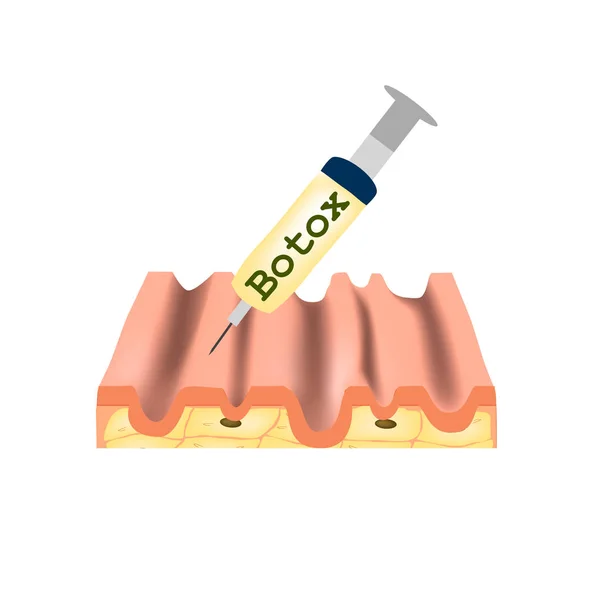 Enrugamentos na pele. Tratamento de rugas botox. Estrutura anatômica da pele. Injeção de Botox. Infográficos. Ilustração vetorial sobre fundo isolado . — Vetor de Stock