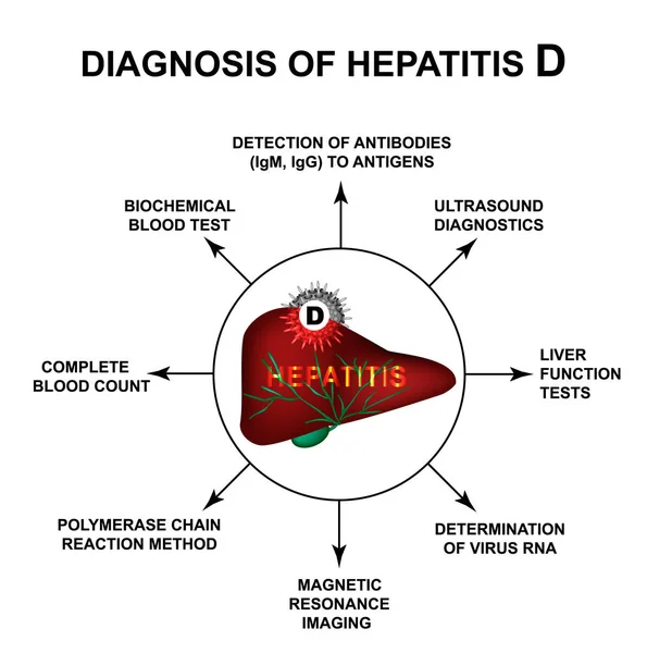 Diagnóstico de hepatitis D. Día Mundial de la Hepatitis. Infografías. Ilustración vectorial sobre fondo aislado . — Vector de stock