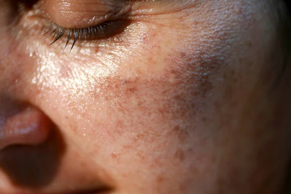 Pigmented spots on the face. Pigmentation on cheeks — Stock Photo, Image
