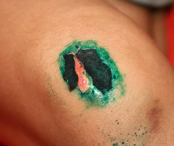 Healing wound on the knee. The wound treated with brilliant green. The scab will climb