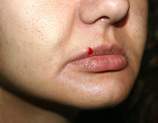 Crack on the lip. Blood on the upper lip — Stock Photo, Image