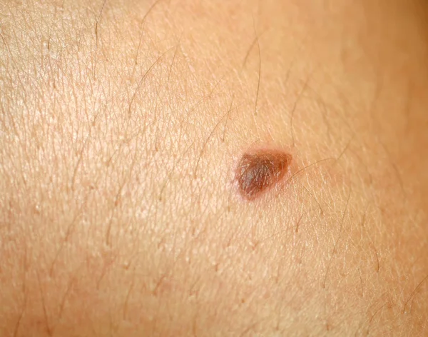 Quemadura en la piel. Blister en la piel — Foto de Stock