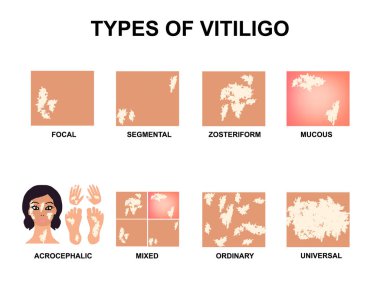 Vitiligo türleri. Dünya Vitiligo Günü. ınfographics. Yalıtılmış arka planda vektör çizimi.