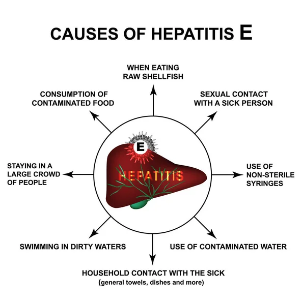 Causas de la hepatitis E. Día Mundial de la Hepatitis. Infografías. Ilustración vectorial sobre fondo aislado . — Vector de stock