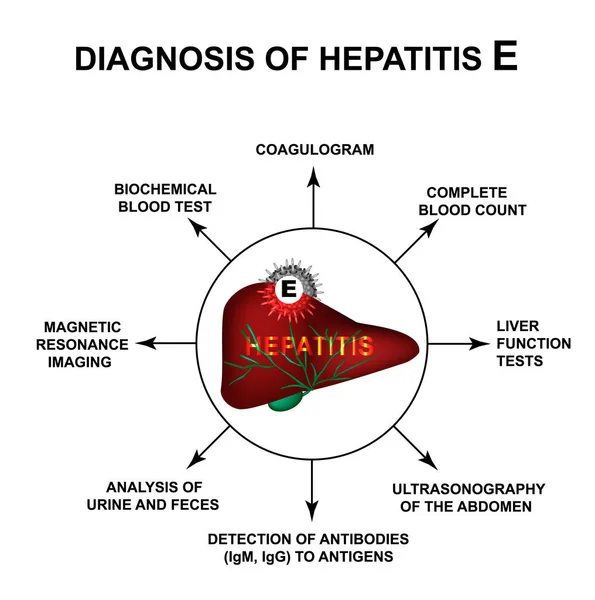 Diagnóstico de hepatitis E. Día Mundial de la Hepatitis. Infografías. Ilustración vectorial sobre fondo aislado . — Vector de stock