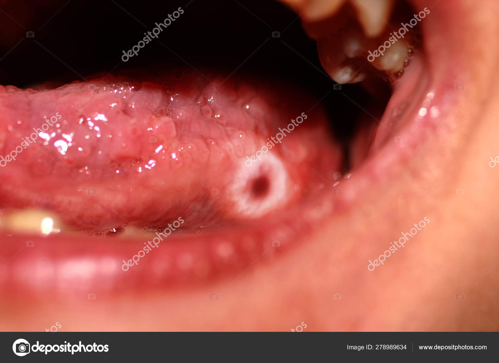 De lengua la hongos fotografias en