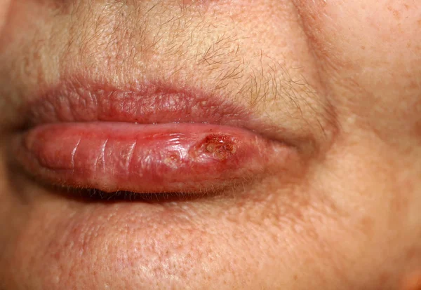 Labios erosionados. Fiebre en el labio. Herpes . — Foto de Stock