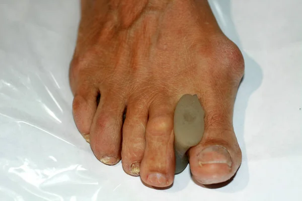 Correction of the curvature of the toe — Stock Photo, Image