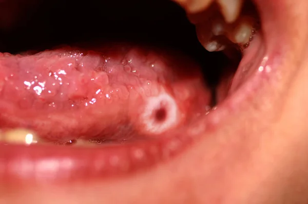 Amphotoid stomatitis. Candidiasis of the tongue. Ulcer on the tongue. Candida fungus. — Stock Photo, Image