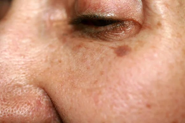 Pigmentación en la cara. Mancha marrón en la mejilla. Mancha de pigmento en la piel . —  Fotos de Stock