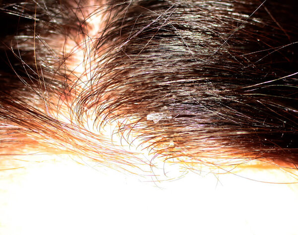 Кривые волосы расстались на голове. Перхоть
.