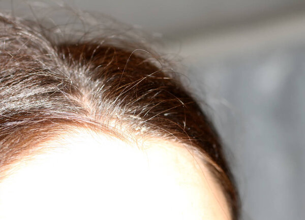 Curve hair parted on the head. Dandruff.
