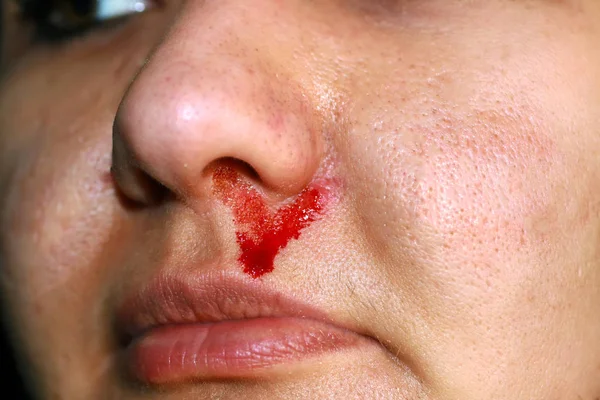 Violência na família. Sangue do nariz de uma mulher. Bater. — Fotografia de Stock