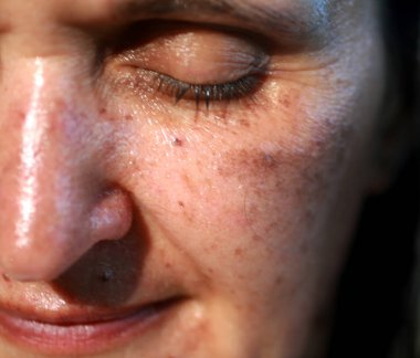 Pigmentli lekeler yüzünde. Yanaklarda pigmentasyon