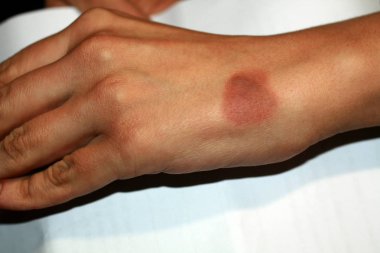 Pigmentasyon. Elinde kahverengi nokta. Ciltte pigment lekesi