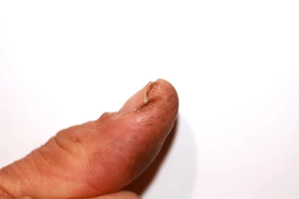 Crack on the thumb. Burr and dirt on the skin. The hand of the working man — Stock Photo, Image