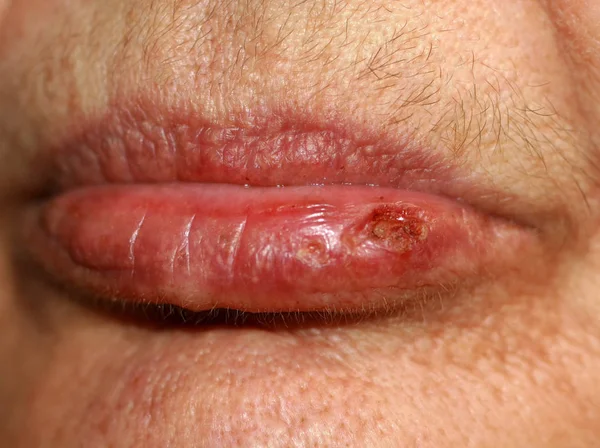 Lábios desgastados. Febre no lábio. Herpes . — Fotografia de Stock