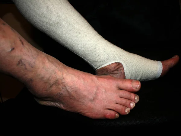 Been. Spataderen. Phlebeurysm. Tromboflebitis. Elastische bandage. — Stockfoto