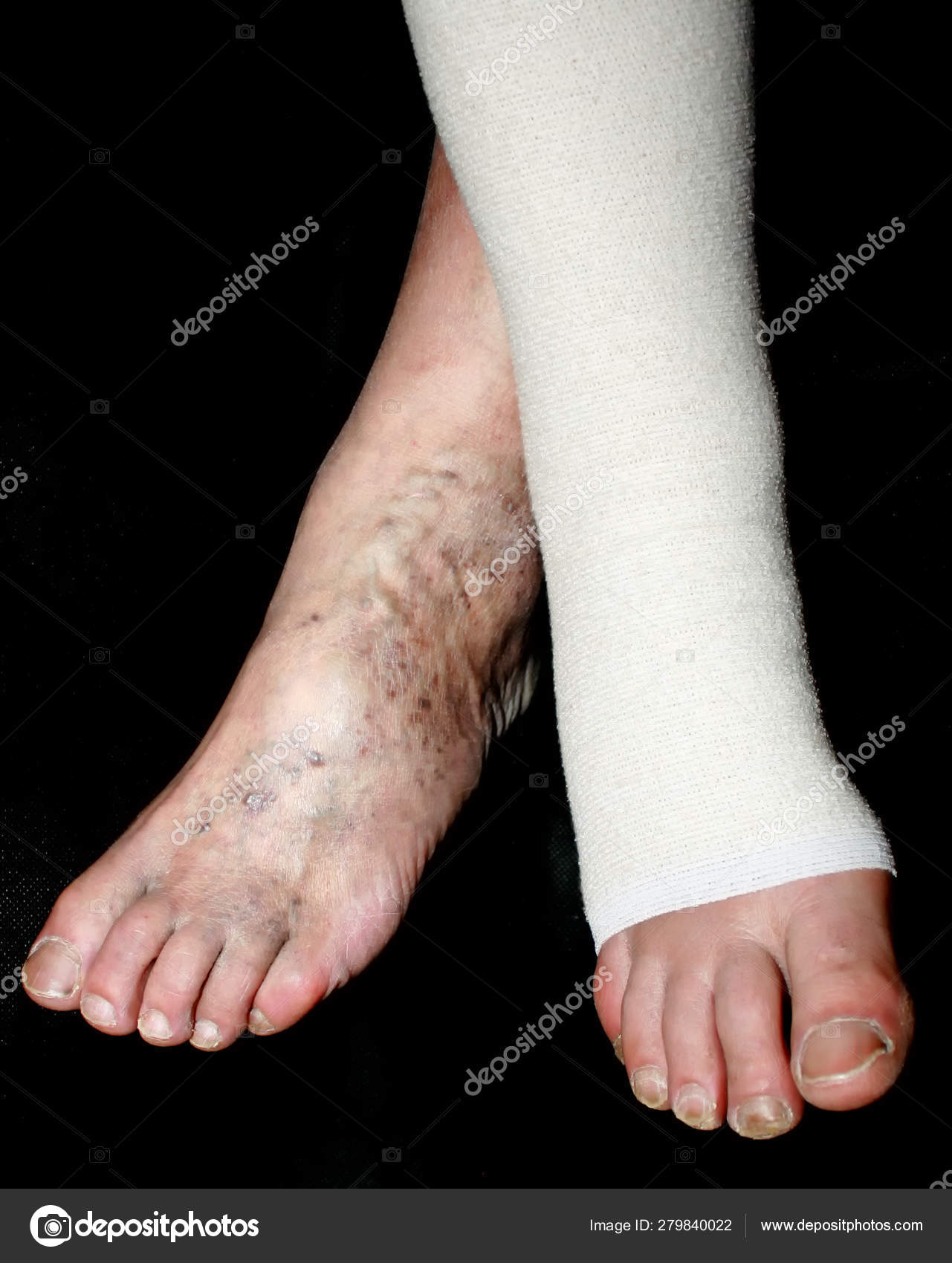 varicose bandages recenzii