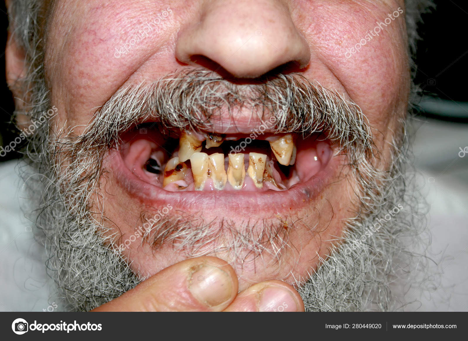 Dents pourries. Barbe et moustache. Des caries. Maladie parodontale. Tartre  dentaire . image libre de droit par mikrostoker © #280449020