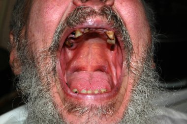 Çürük dişler kötü. Sakal ve bıyık. Çürük. Periodontal hastalık. Diş tartar.