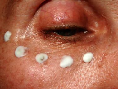 Gözlerinin altında Kırışıklık krem uygulama. Göz kapağı kırışıklıkları.