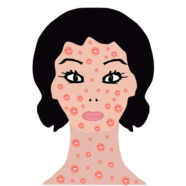 Eruzione cutanea su viso e collo. Allergia, dermatite, acne, brufoli. Infografica. Illustrazione vettoriale su sfondo isolato . — Vettoriale Stock