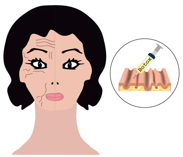 Arrugas en la mitad de la cara. Tratamiento con Botox. Inyecciones de Botox. Infografías. Ilustración vectorial sobre fondo aislado . — Vector de stock