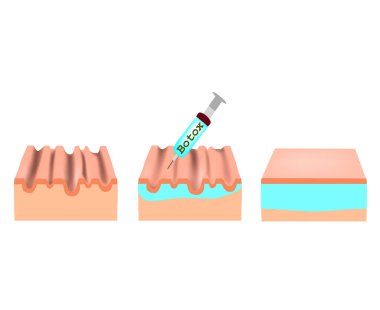 Ciltte kırışıklıklar. Botox kırışıklık tedavisi. Anatomik deri yapısı. Botoks enjeksiyonu. ınfographics. Yalıtılmış arka planda vektör çizimi.