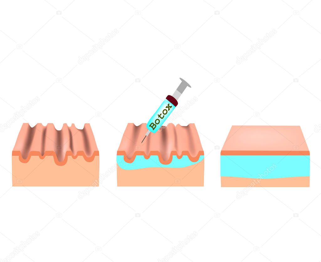 Wrinkles on the skin. Botox wrinkle treatment. Anatomical skin structure. Botox injection. Infographics. Vector illustration on isolated background.