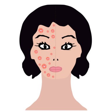 Yüzünde kızarıklık var. Alerji, dermatit, akne, sivilce. ınfographics. Yalıtılmış arka planda vektör çizimi.