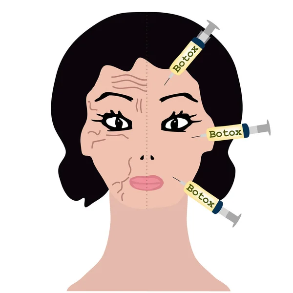 Rugas numa metade da cara. Tratamento de Botox. Injeções de Botox. Infográficos. Ilustração vetorial sobre fundo isolado . — Vetor de Stock